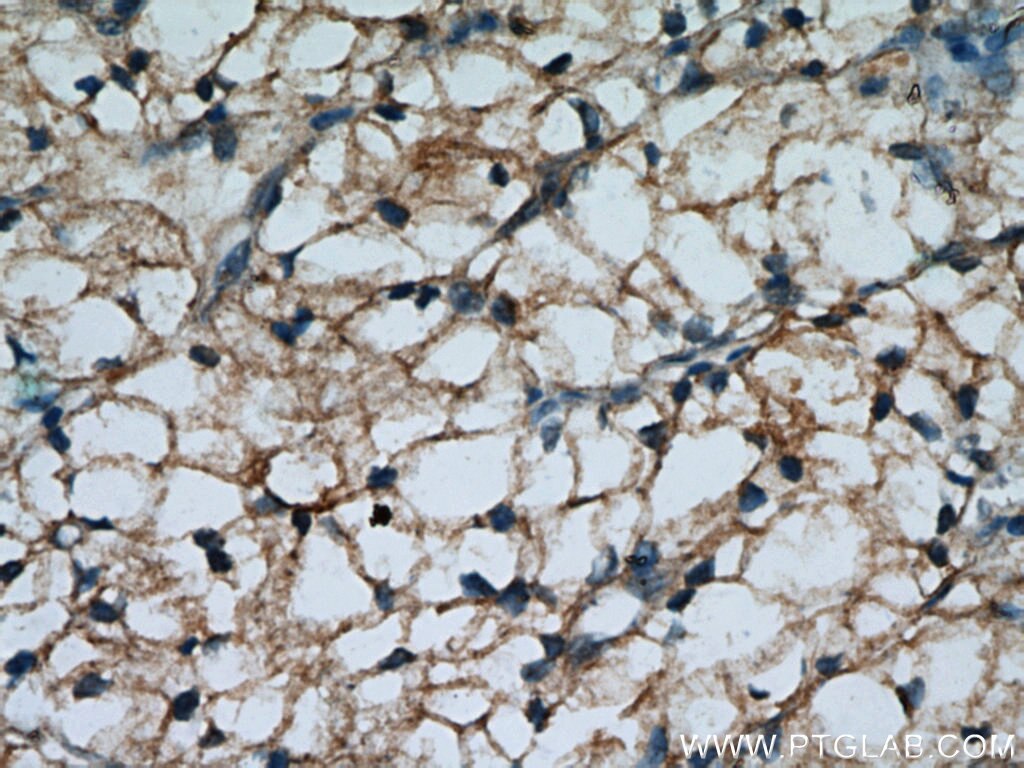 Immunohistochemistry (IHC) staining of human renal cell carcinoma tissue using MME,CD10 Polyclonal antibody (10302-1-AP)