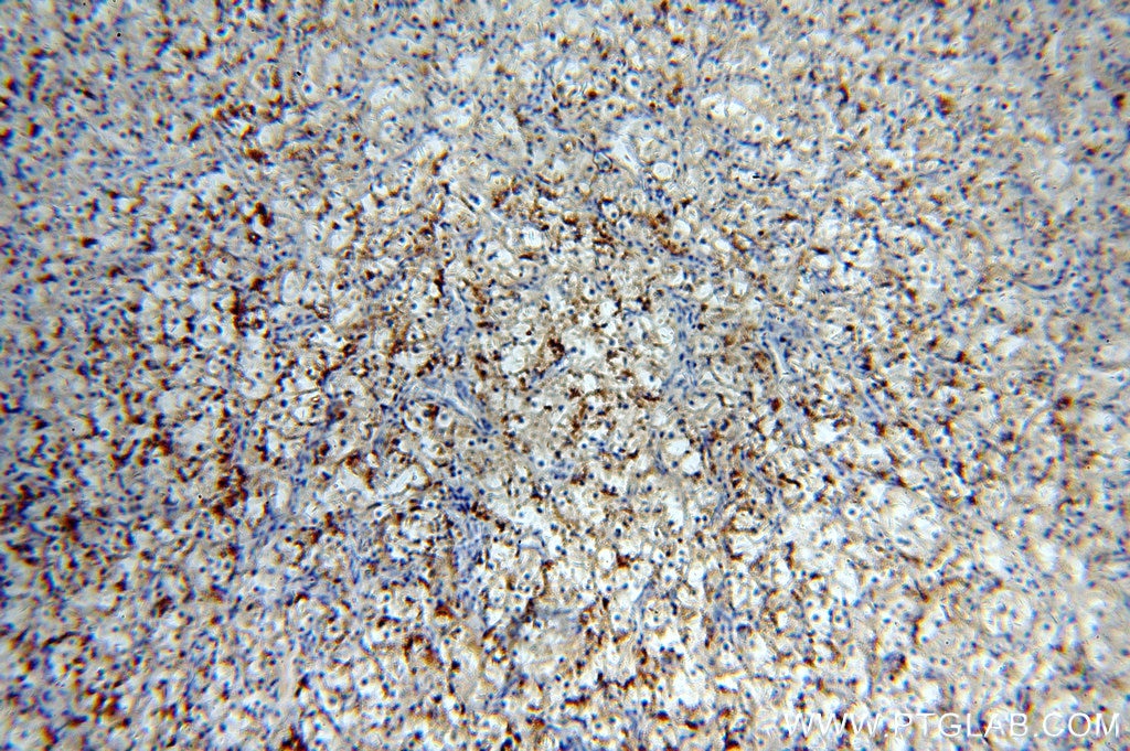 Immunohistochemistry (IHC) staining of human renal cell carcinoma tissue using MME,CD10 Polyclonal antibody (18008-1-AP)