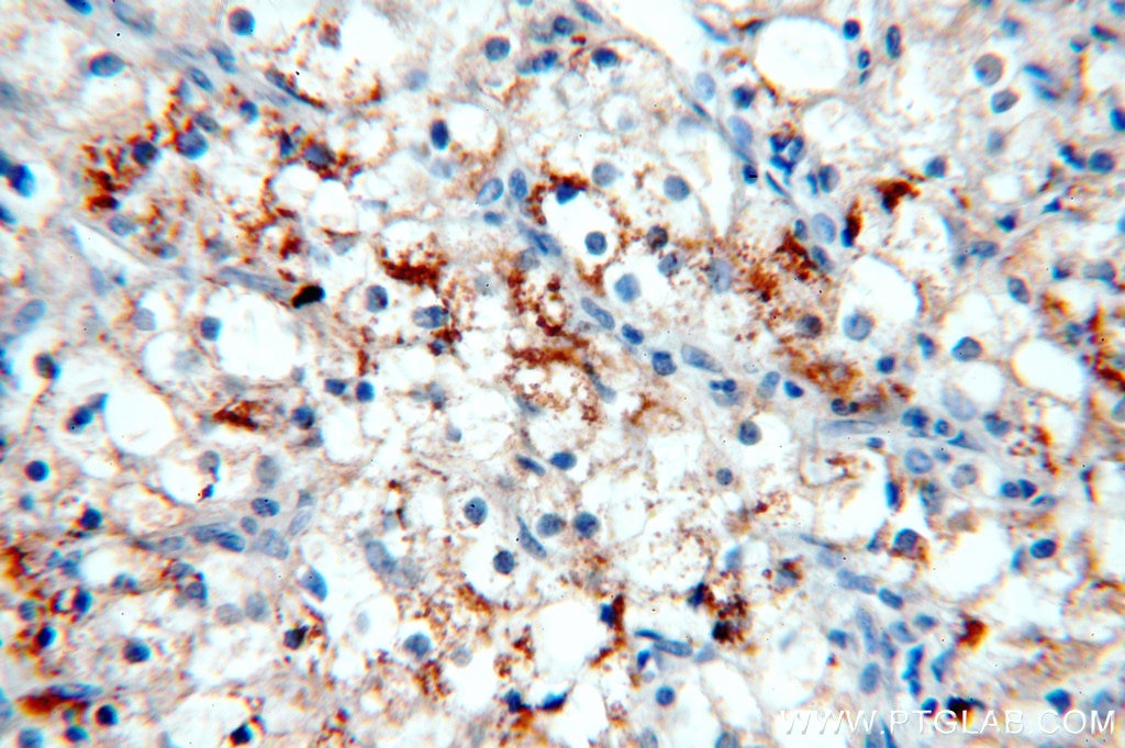 Immunohistochemistry (IHC) staining of human renal cell carcinoma tissue using MME,CD10 Polyclonal antibody (18008-1-AP)