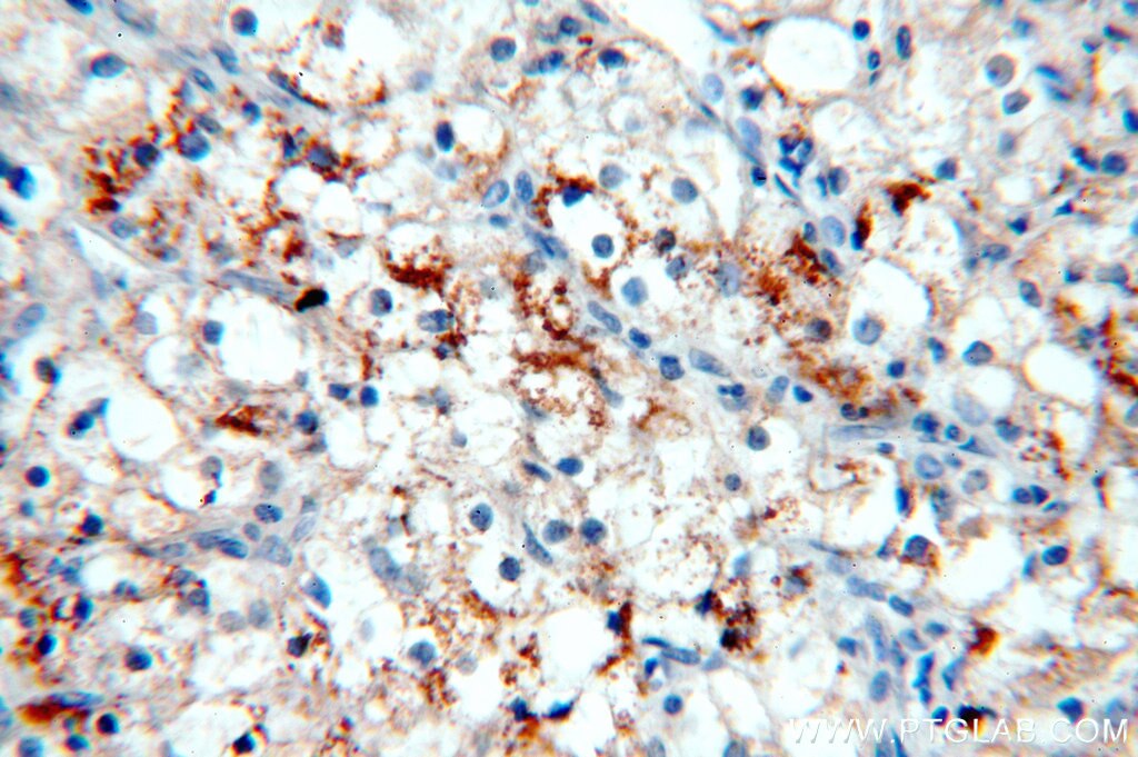 Immunohistochemistry (IHC) staining of human renal cell carcinoma tissue using MME,CD10 Polyclonal antibody (18008-1-AP)