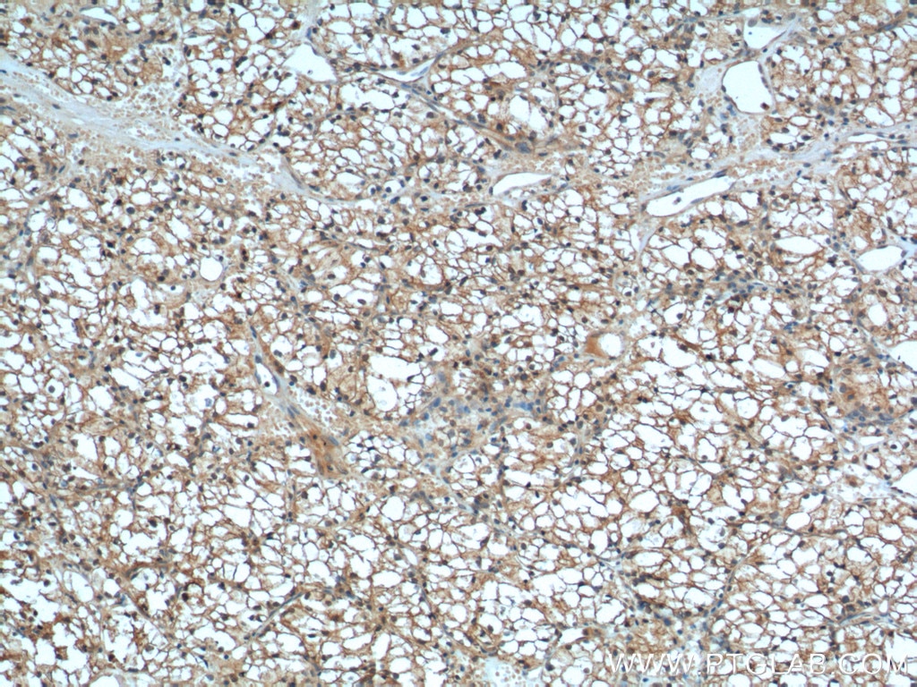 Immunohistochemistry (IHC) staining of human renal cell carcinoma tissue using MME,CD10 Monoclonal antibody (60034-3-Ig)
