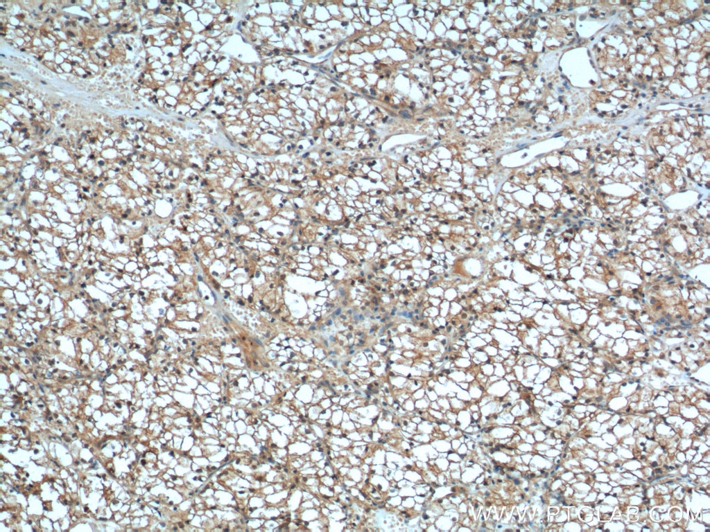 IHC staining of human renal cell carcinoma using 60034-3-Ig