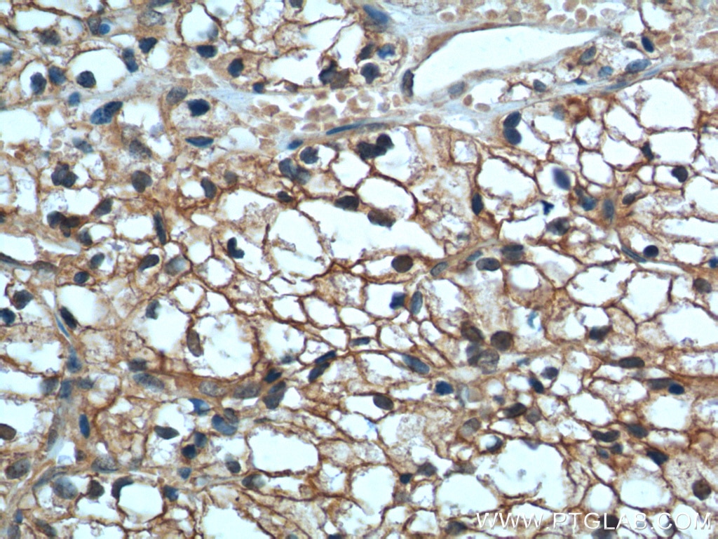 IHC staining of human renal cell carcinoma using 60034-3-Ig