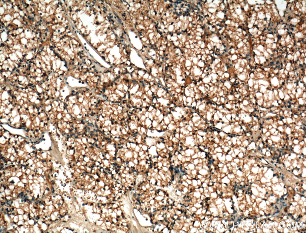 IHC staining of human renal cell carcinoma using 60034-3-Ig