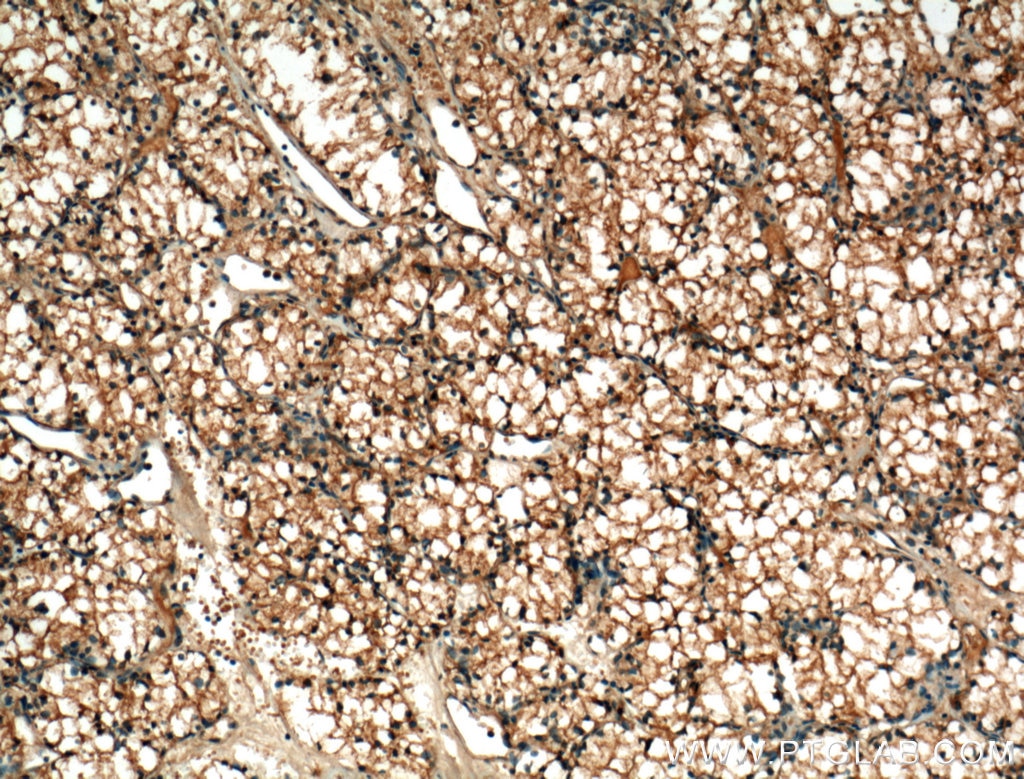 Immunohistochemistry (IHC) staining of human renal cell carcinoma tissue using MME,CD10 Monoclonal antibody (60034-3-Ig)