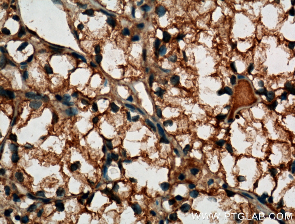 IHC staining of human renal cell carcinoma using 60034-3-Ig