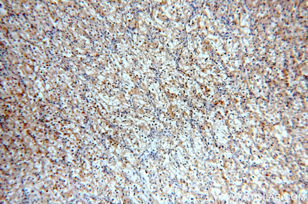 IHC staining of human renal cell carcinoma using 60034-3-Ig