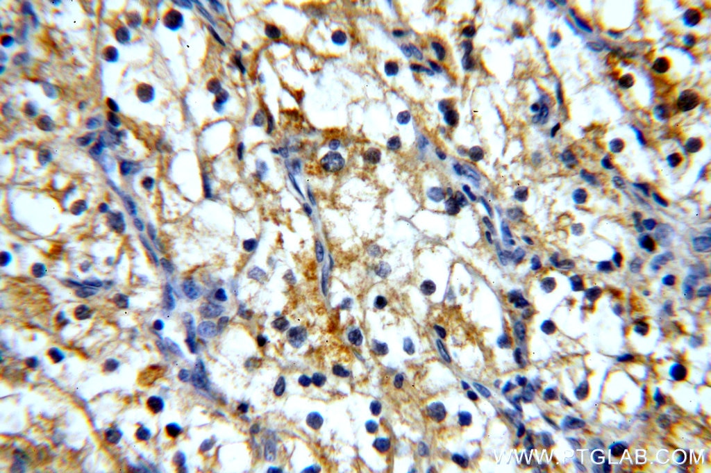 Immunohistochemistry (IHC) staining of human renal cell carcinoma tissue using MME,CD10 Monoclonal antibody (60034-3-Ig)