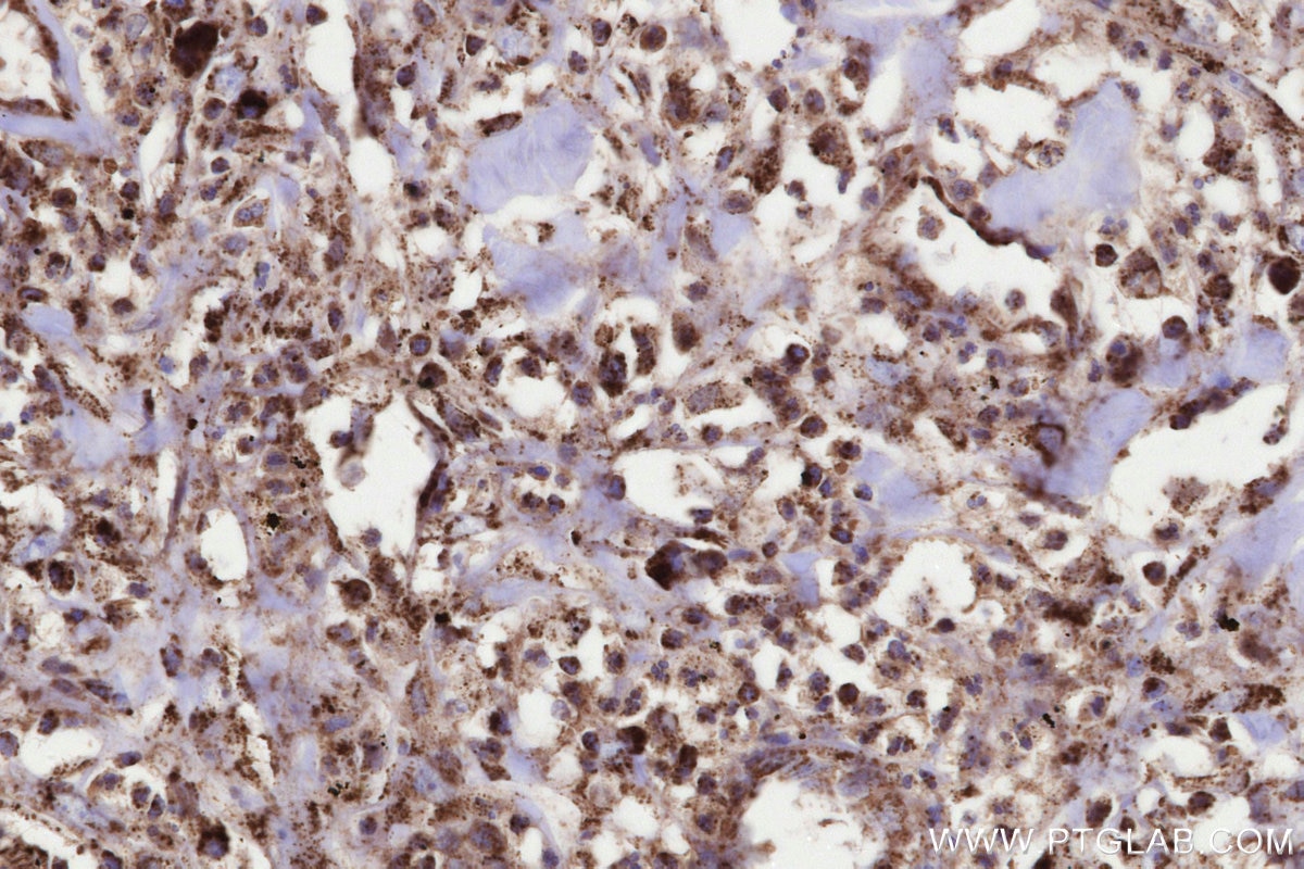 Immunohistochemistry (IHC) staining of human colon cancer tissue using MMGT1 Polyclonal antibody (31166-1-AP)