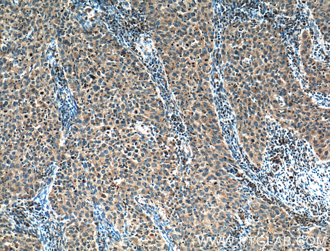 Immunohistochemistry (IHC) staining of human cervical cancer tissue using MMP1 Polyclonal antibody (26585-1-AP)