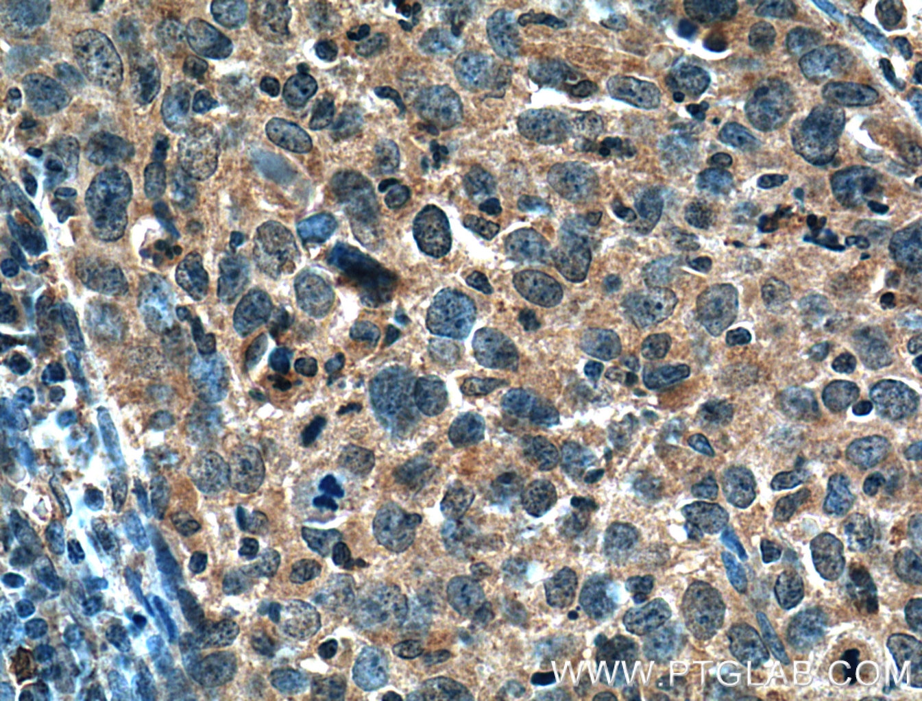 IHC staining of human cervical cancer using 26585-1-AP