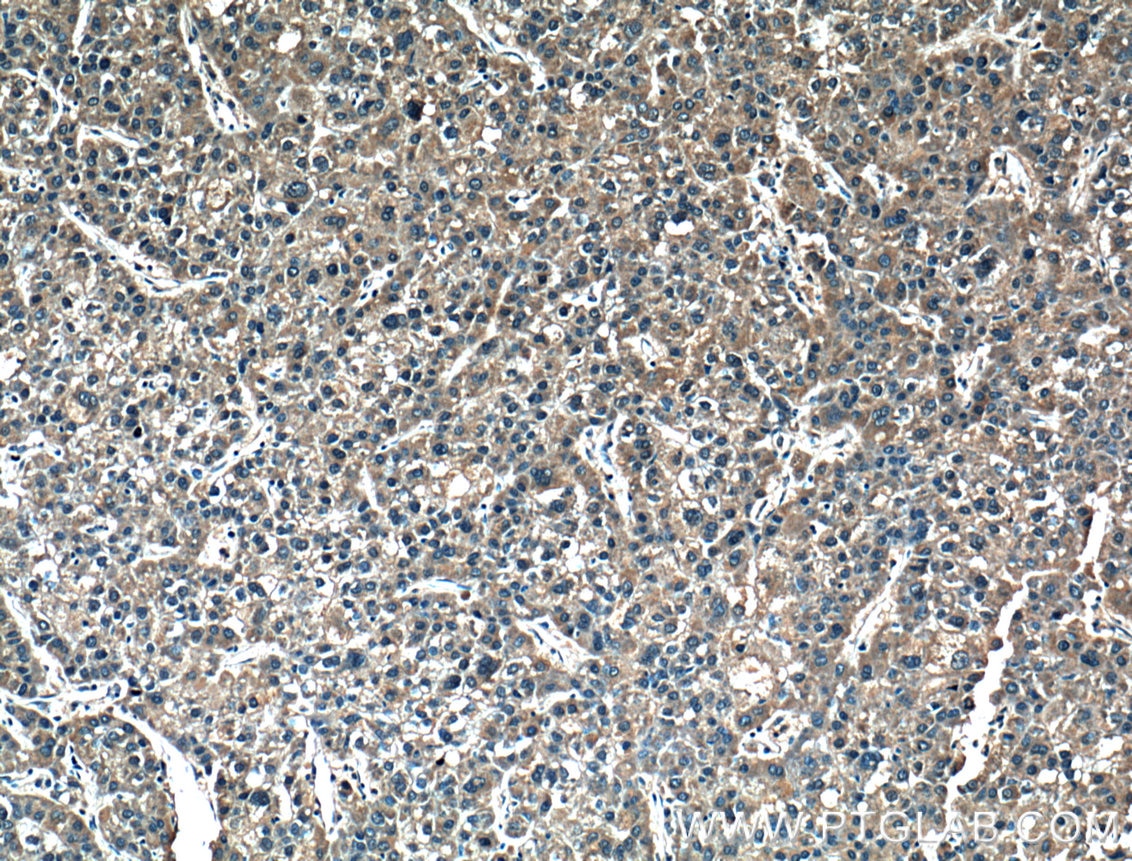 Immunohistochemistry (IHC) staining of human liver cancer tissue using MMP1 Polyclonal antibody (26585-1-AP)