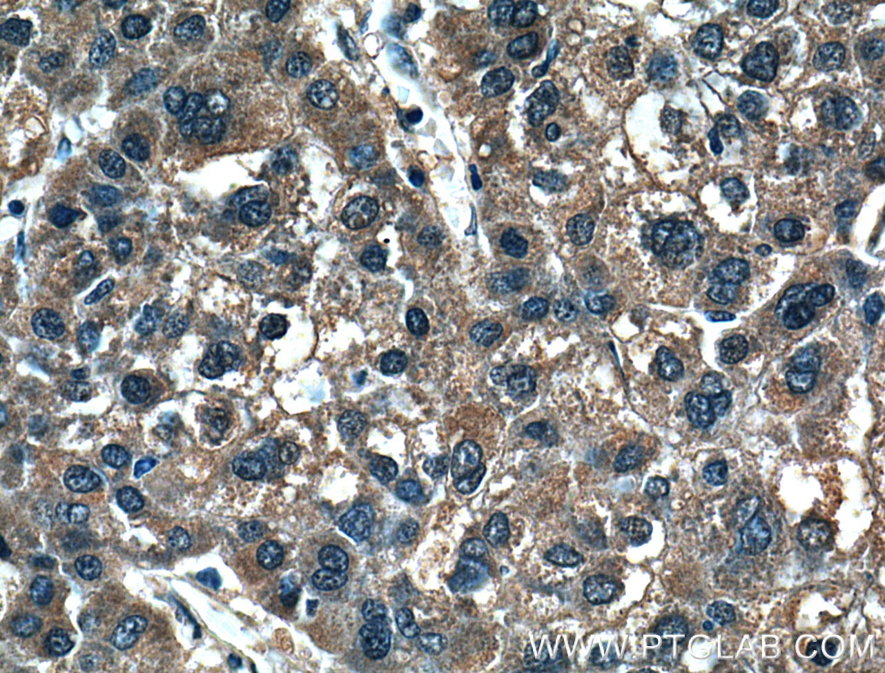 Immunohistochemistry (IHC) staining of human liver cancer tissue using MMP1 Polyclonal antibody (26585-1-AP)