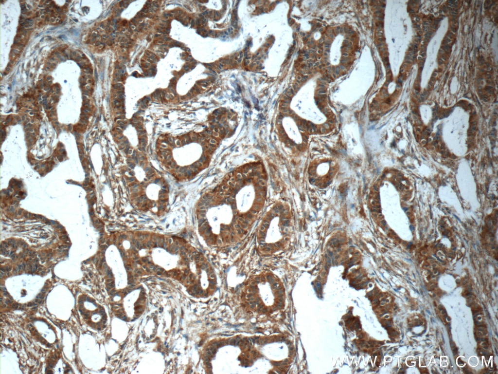 Immunohistochemistry (IHC) staining of human breast cancer tissue using MMP12 Polyclonal antibody (22989-1-AP)