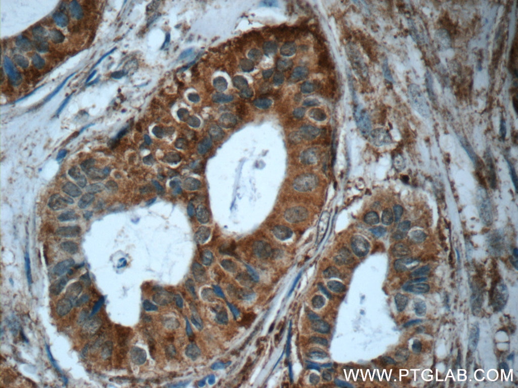 Immunohistochemistry (IHC) staining of human breast cancer tissue using MMP12 Polyclonal antibody (22989-1-AP)