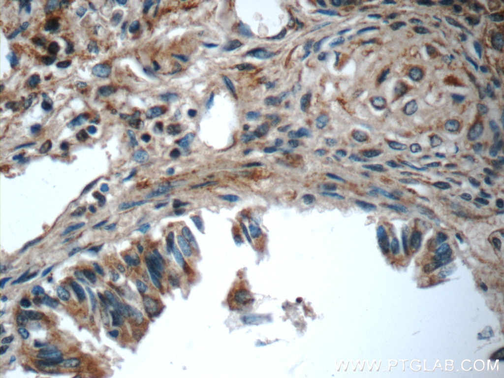 Immunohistochemistry (IHC) staining of human lung tissue using MMP12 Polyclonal antibody (22989-1-AP)