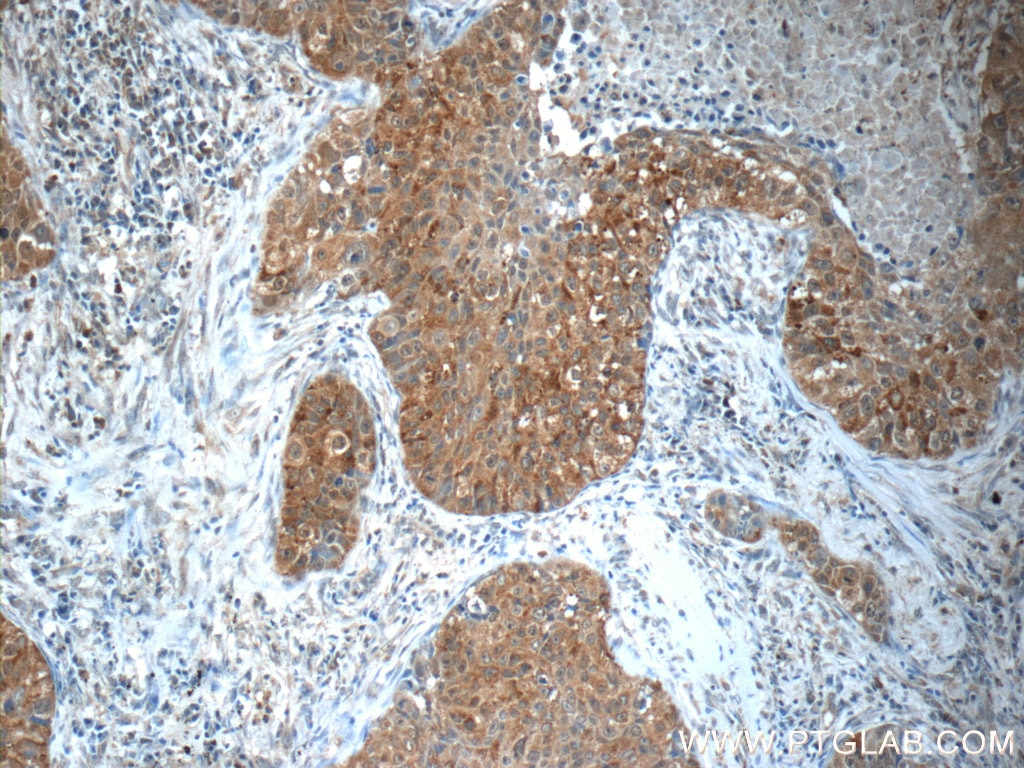 Immunohistochemistry (IHC) staining of human lung cancer tissue using MMP12 Polyclonal antibody (22989-1-AP)