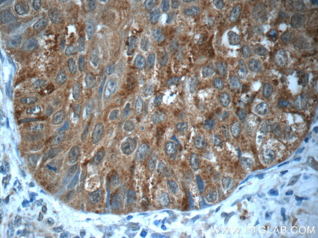 Immunohistochemistry (IHC) staining of human lung cancer tissue using MMP12 Polyclonal antibody (22989-1-AP)
