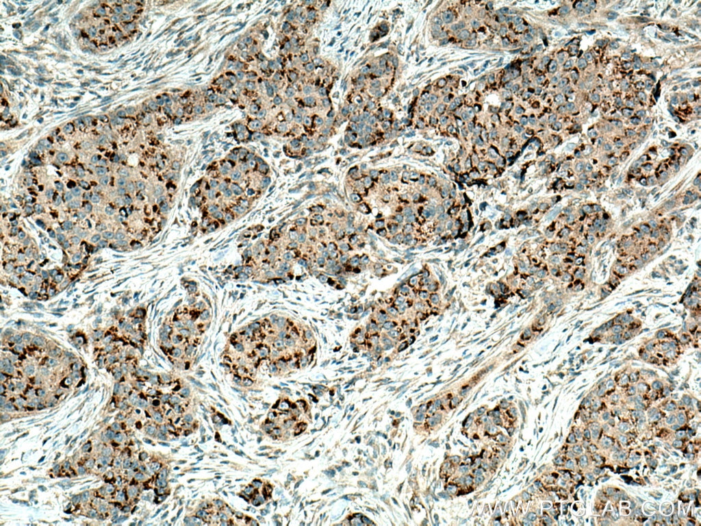 Immunohistochemistry (IHC) staining of human breast cancer tissue using MMP12 Polyclonal antibody (22989-1-AP)