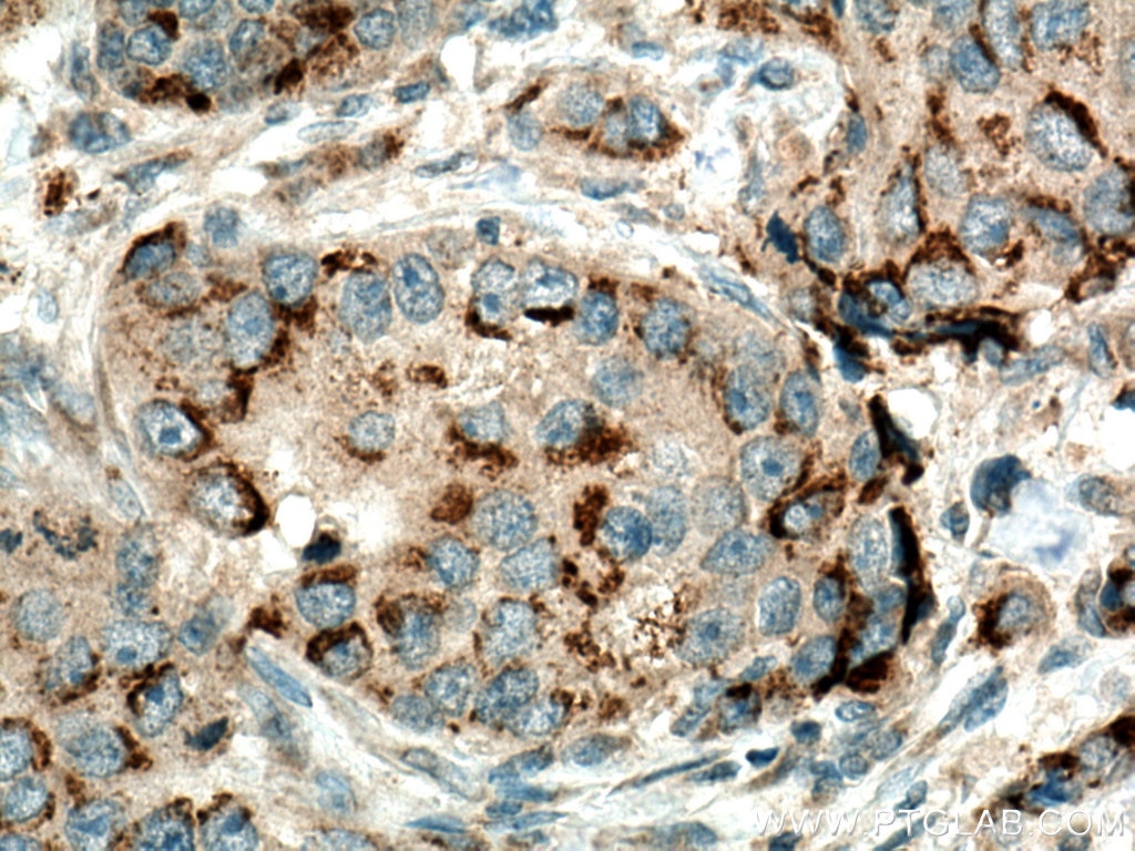 Immunohistochemistry (IHC) staining of human breast cancer tissue using MMP12 Polyclonal antibody (22989-1-AP)