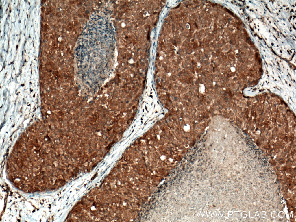 Immunohistochemistry (IHC) staining of human breast cancer tissue using MMP13 Polyclonal antibody (18165-1-AP)