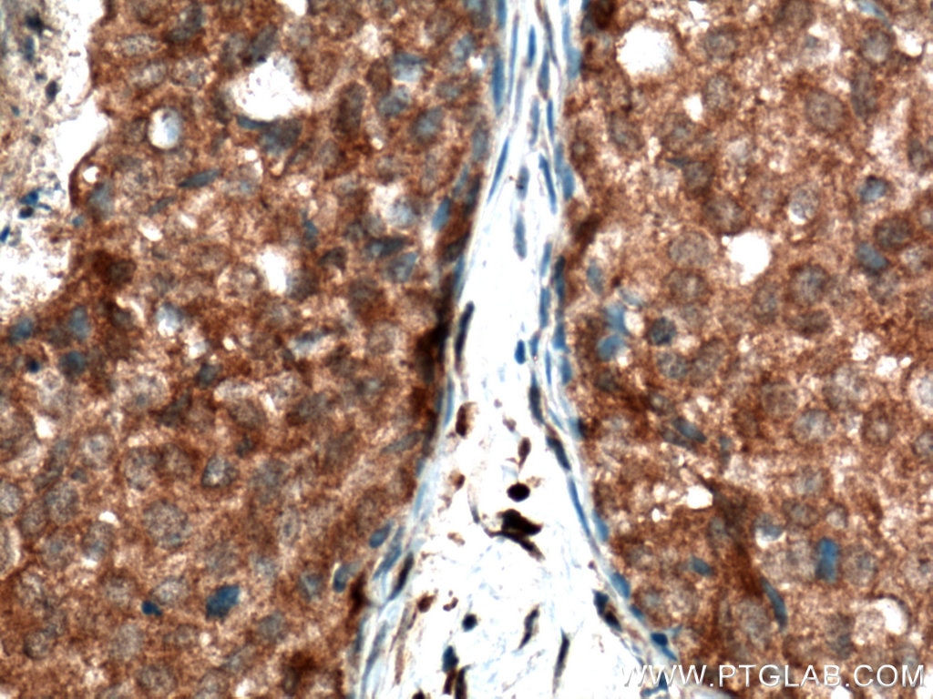 IHC staining of human breast cancer using 18165-1-AP