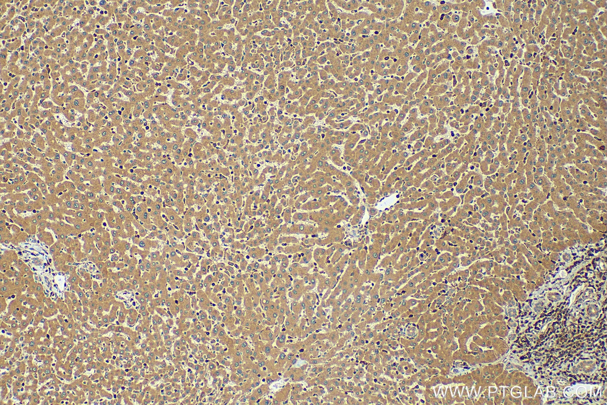 Immunohistochemistry (IHC) staining of human hepatocirrhosis tissue using MMP13 Polyclonal antibody (18165-1-AP)