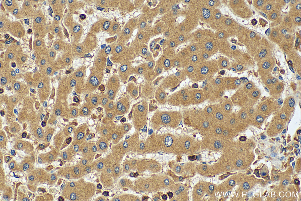 Immunohistochemistry (IHC) staining of human hepatocirrhosis tissue using MMP13 Polyclonal antibody (18165-1-AP)