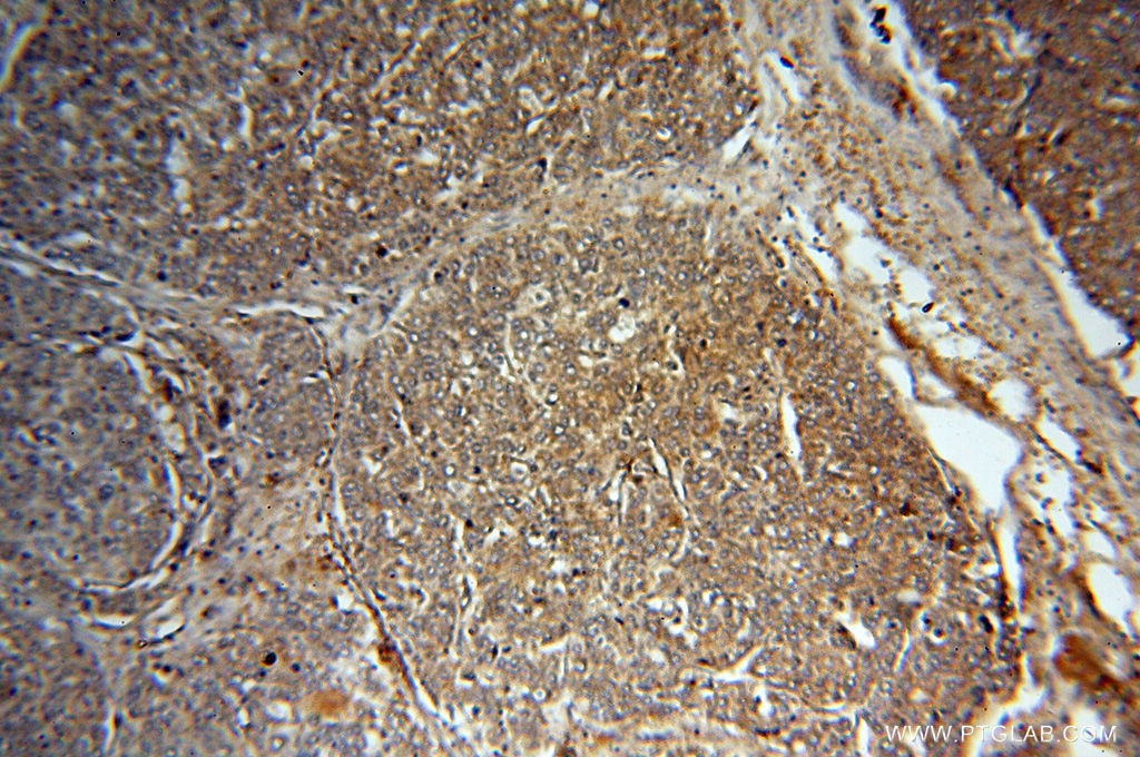 Immunohistochemistry (IHC) staining of human liver cancer tissue using MMP13 Polyclonal antibody (18165-1-AP)