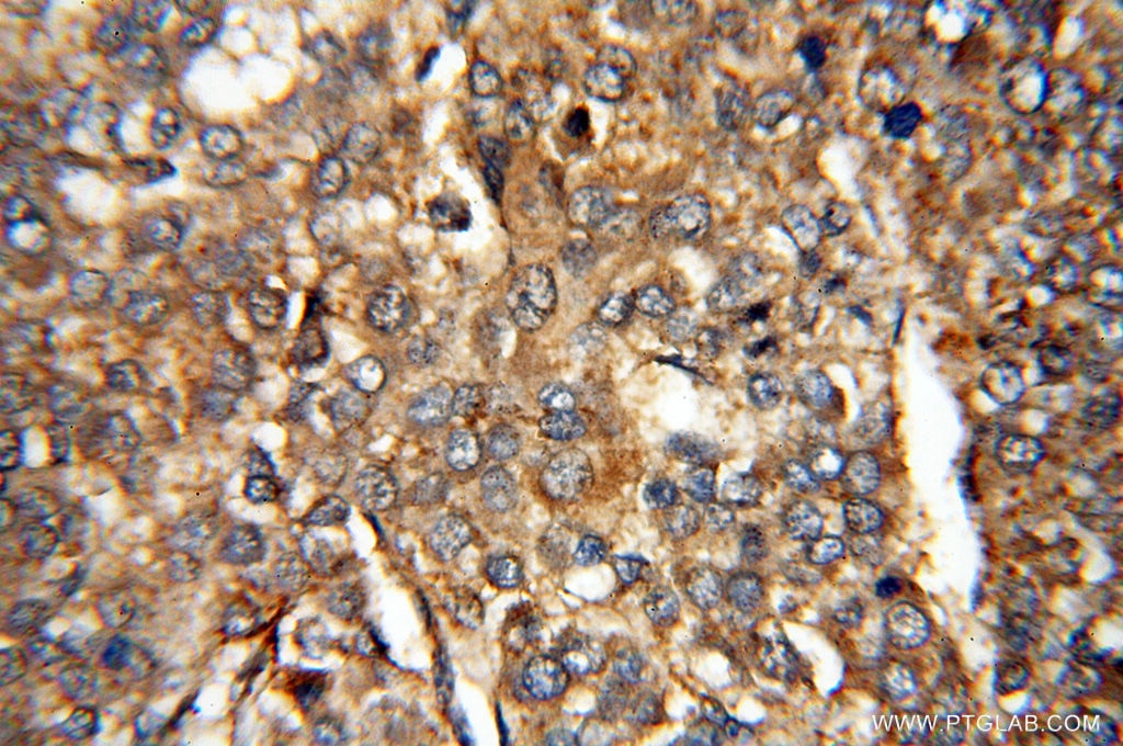 Immunohistochemistry (IHC) staining of human liver cancer tissue using MMP13 Polyclonal antibody (18165-1-AP)