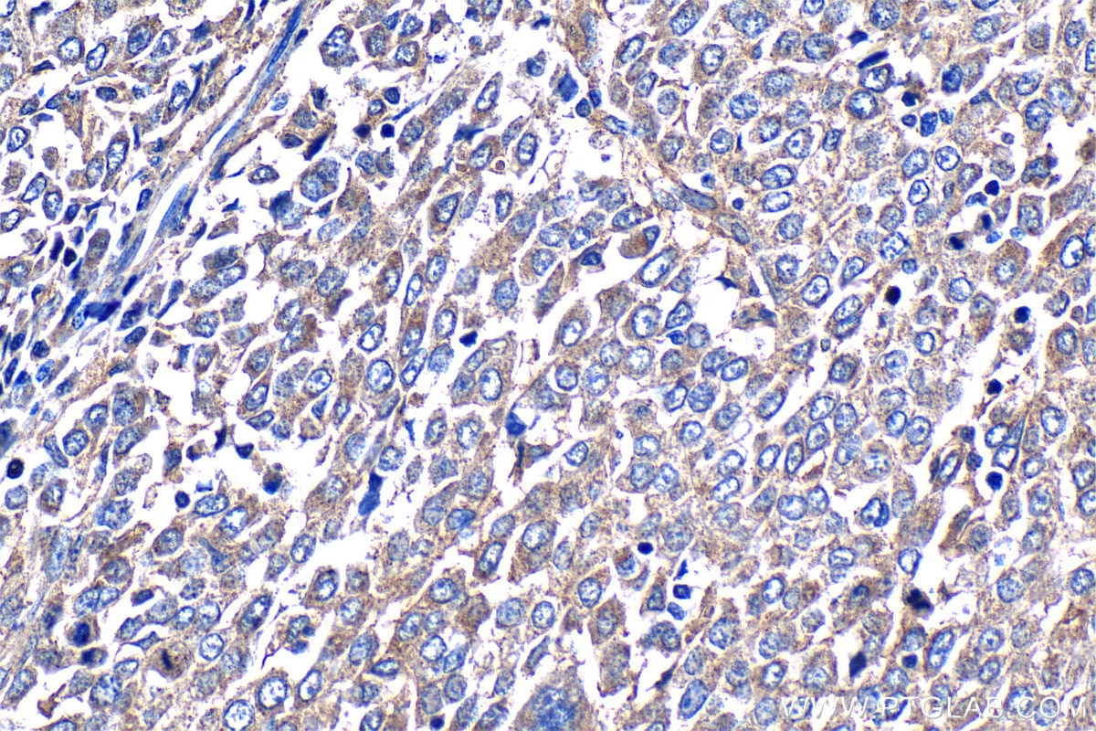 Immunohistochemistry (IHC) staining of human ovary tumor tissue using MMP14 / MT1-MMP Polyclonal antibody (14552-1-AP)