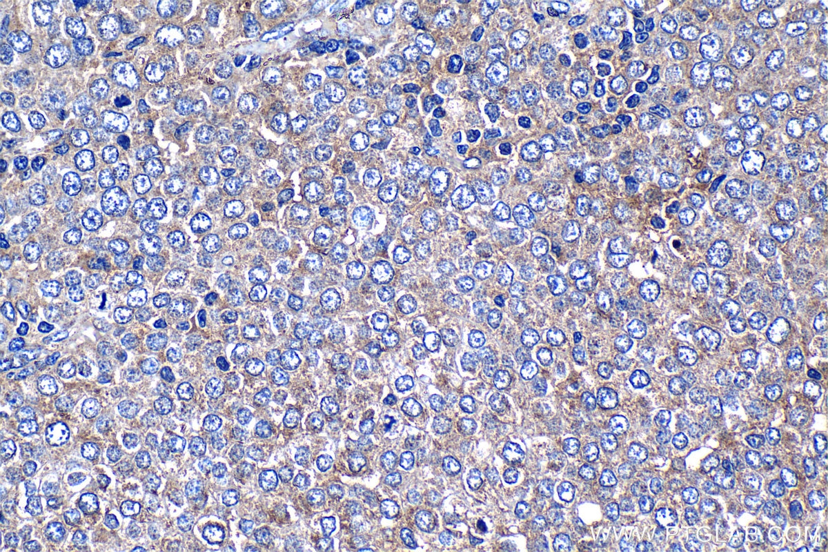 Immunohistochemistry (IHC) staining of human ovary tumor tissue using MMP14 / MT1-MMP Polyclonal antibody (14552-1-AP)