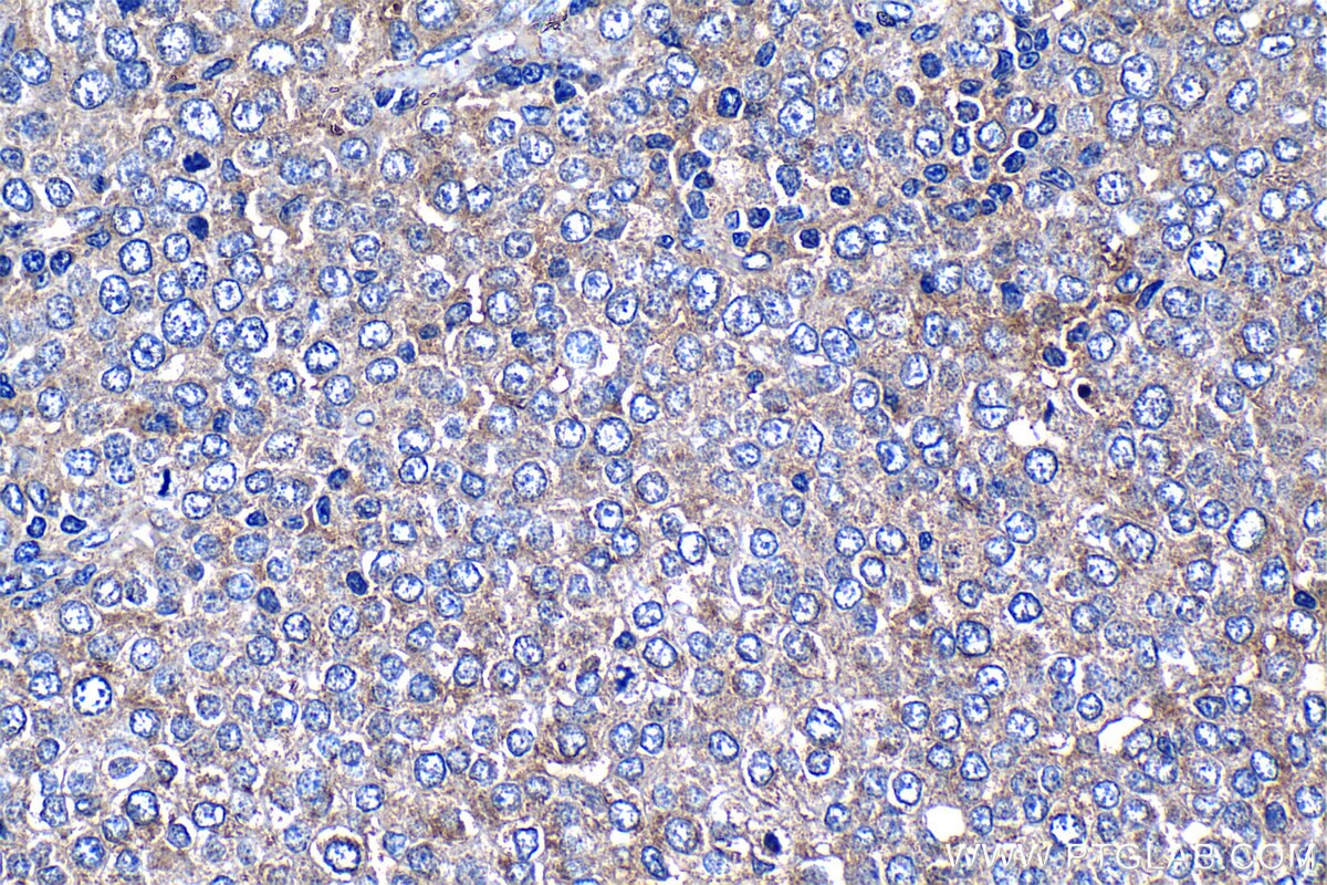 IHC staining of human ovary tumor using 14552-1-AP