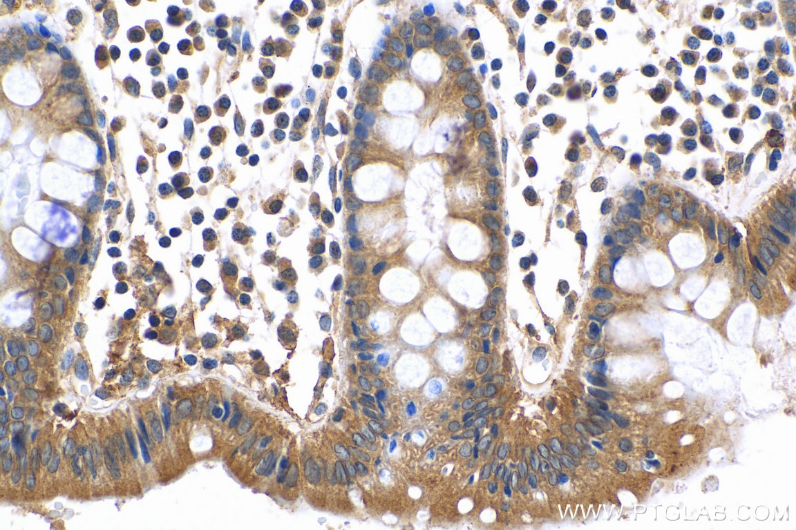 Immunohistochemistry (IHC) staining of human colon cancer tissue using MMP14 / MT1-MMP Polyclonal antibody (29111-1-AP)