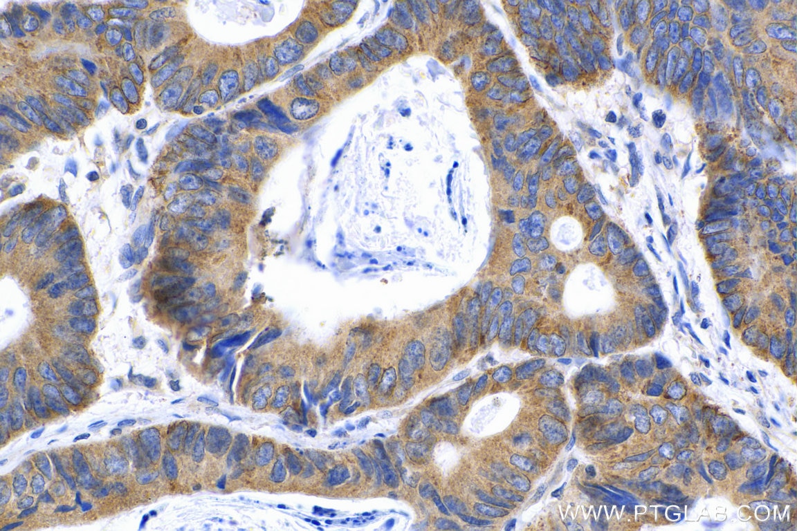 Immunohistochemistry (IHC) staining of human colon cancer tissue using MMP14 / MT1-MMP Polyclonal antibody (29111-1-AP)