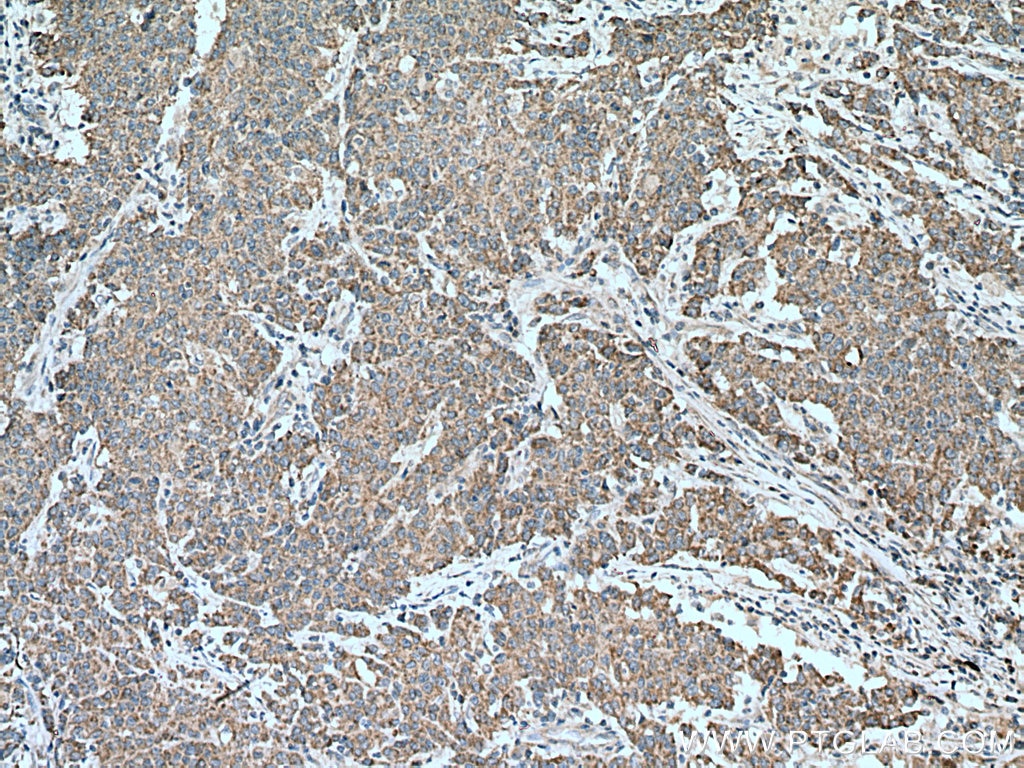 Immunohistochemistry (IHC) staining of human stomach cancer tissue using MMP17 Polyclonal antibody (28429-1-AP)