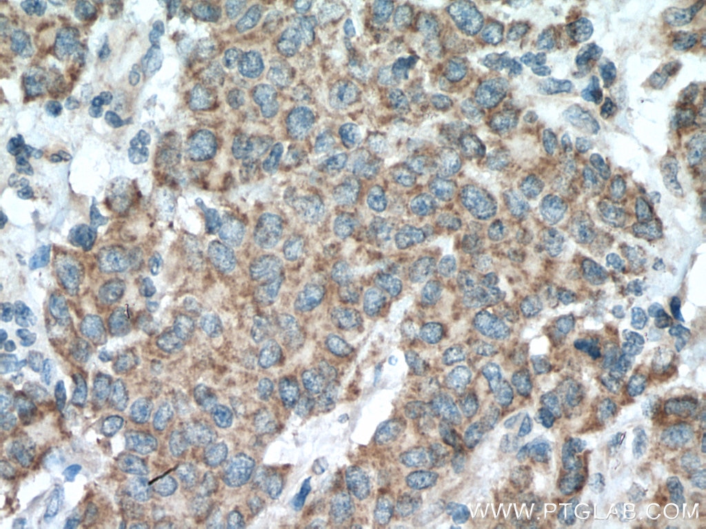 Immunohistochemistry (IHC) staining of human stomach cancer tissue using MMP17 Polyclonal antibody (28429-1-AP)