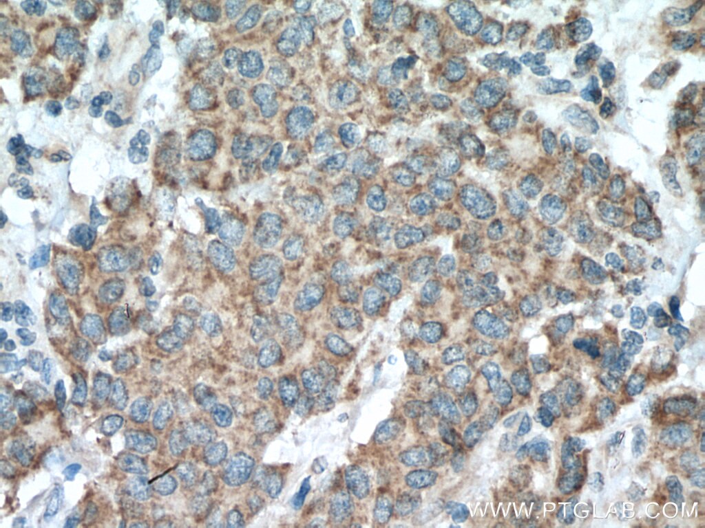 Immunohistochemistry (IHC) staining of human stomach cancer tissue using MMP17 Polyclonal antibody (28429-1-AP)