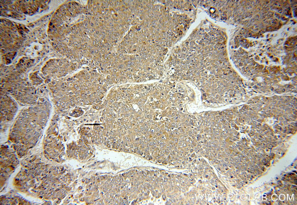 Immunohistochemistry (IHC) staining of human liver cancer tissue using MMP19 Polyclonal antibody (14244-1-AP)