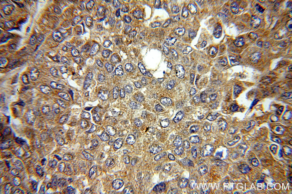 Immunohistochemistry (IHC) staining of human liver cancer tissue using MMP19 Polyclonal antibody (14244-1-AP)