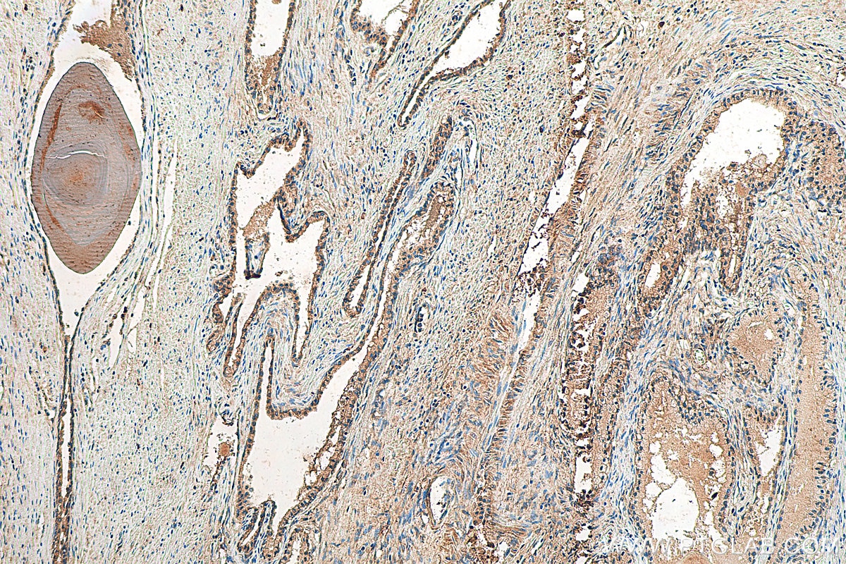 Immunohistochemistry (IHC) staining of human prostate cancer tissue using MMP2 Polyclonal antibody (10373-2-AP)
