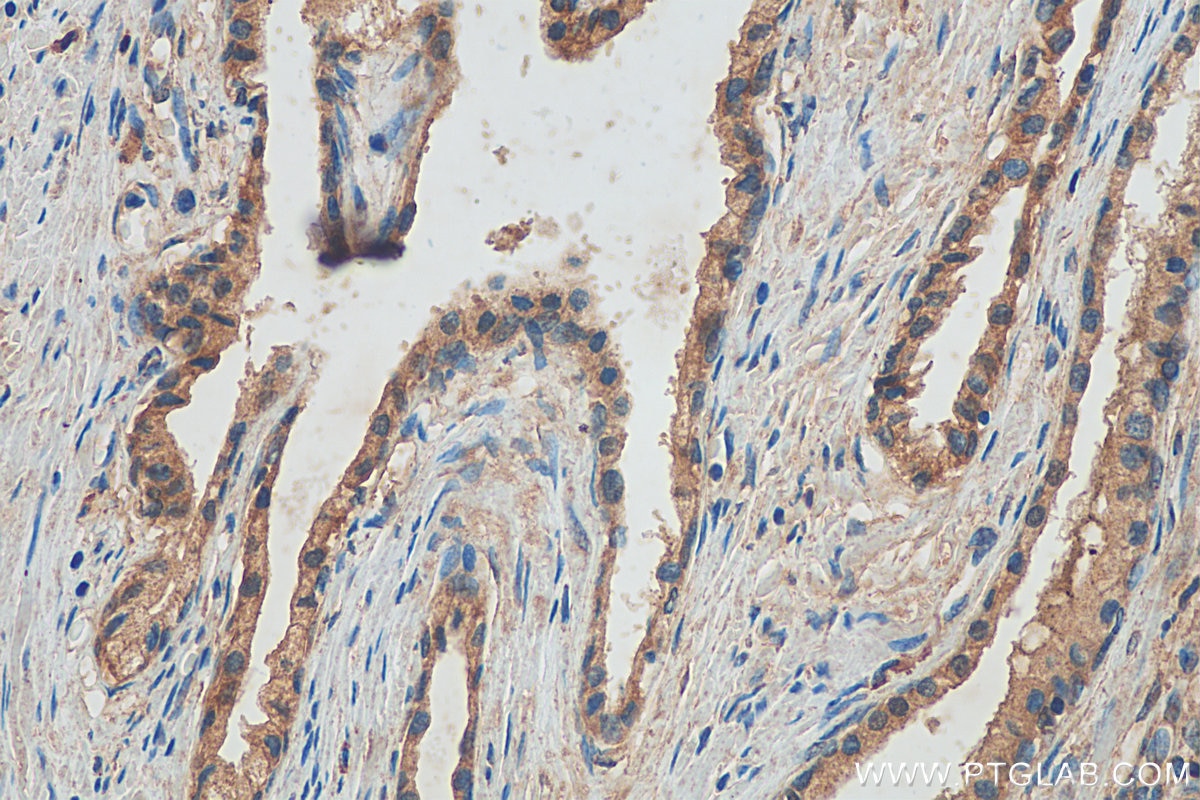 IHC staining of human prostate cancer using 10373-2-AP