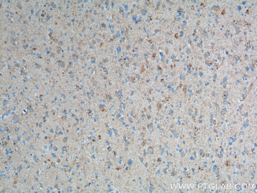 Immunohistochemistry (IHC) staining of human gliomas tissue using MMP2 Polyclonal antibody (10373-2-AP)