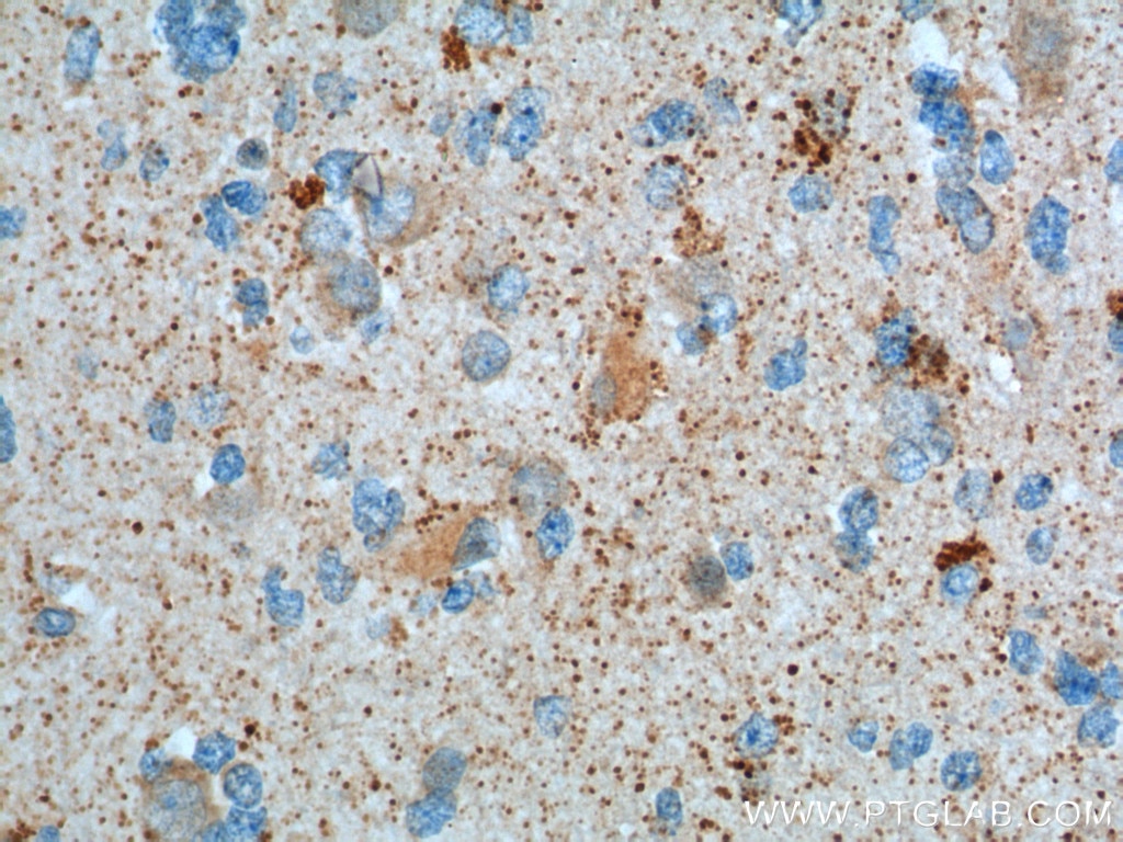 IHC staining of human gliomas using 10373-2-AP
