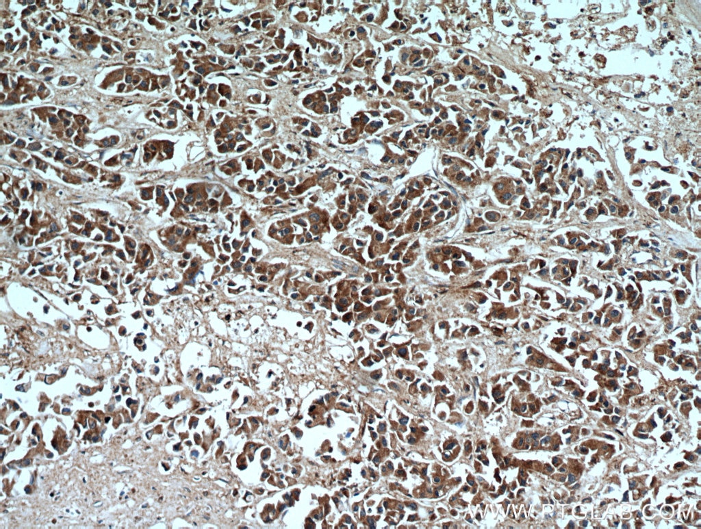 IHC staining of human breast cancer using 10373-2-AP