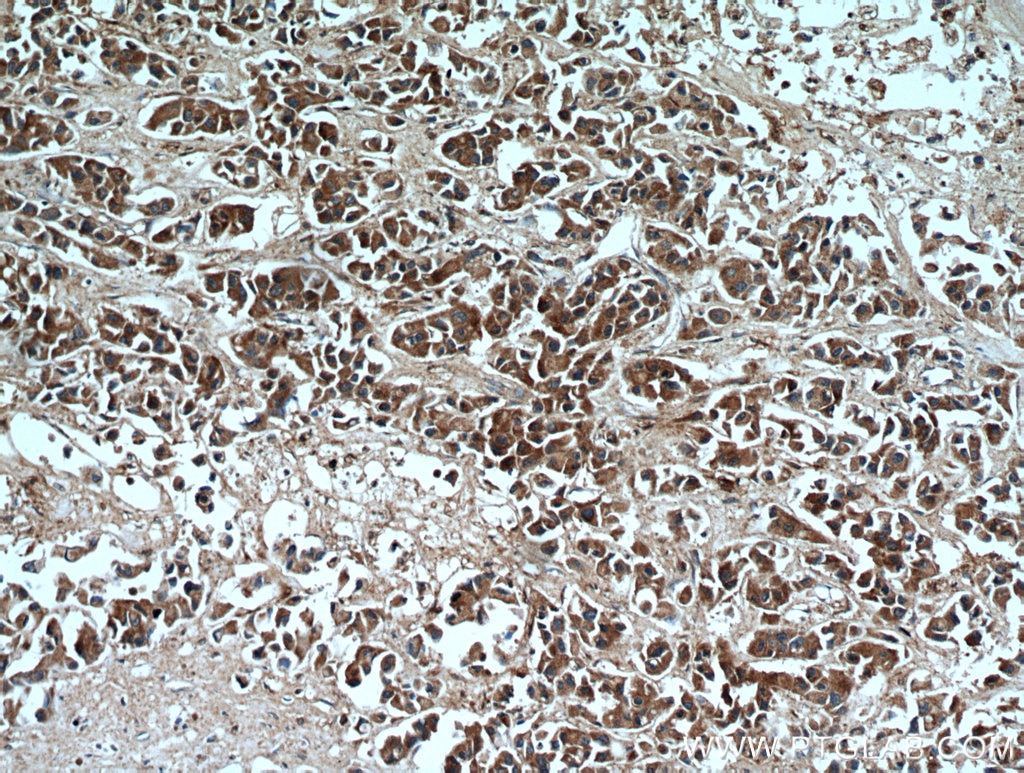 Immunohistochemistry (IHC) staining of human breast cancer tissue using MMP2 Polyclonal antibody (10373-2-AP)