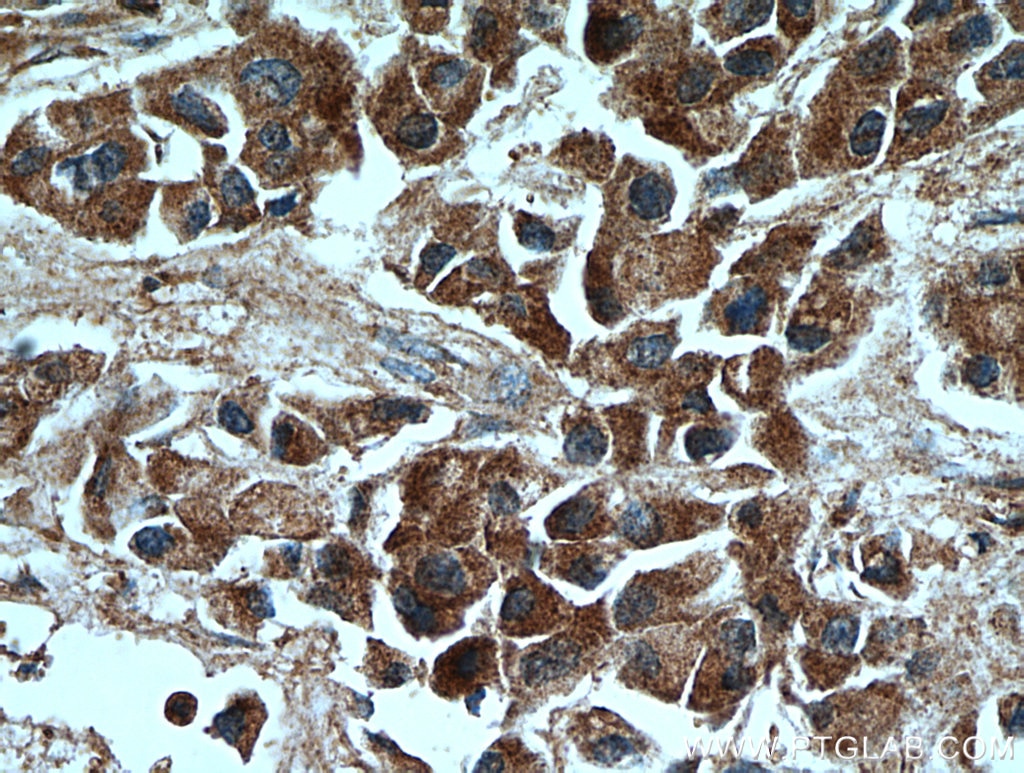 Immunohistochemistry (IHC) staining of human breast cancer tissue using MMP2 Polyclonal antibody (10373-2-AP)