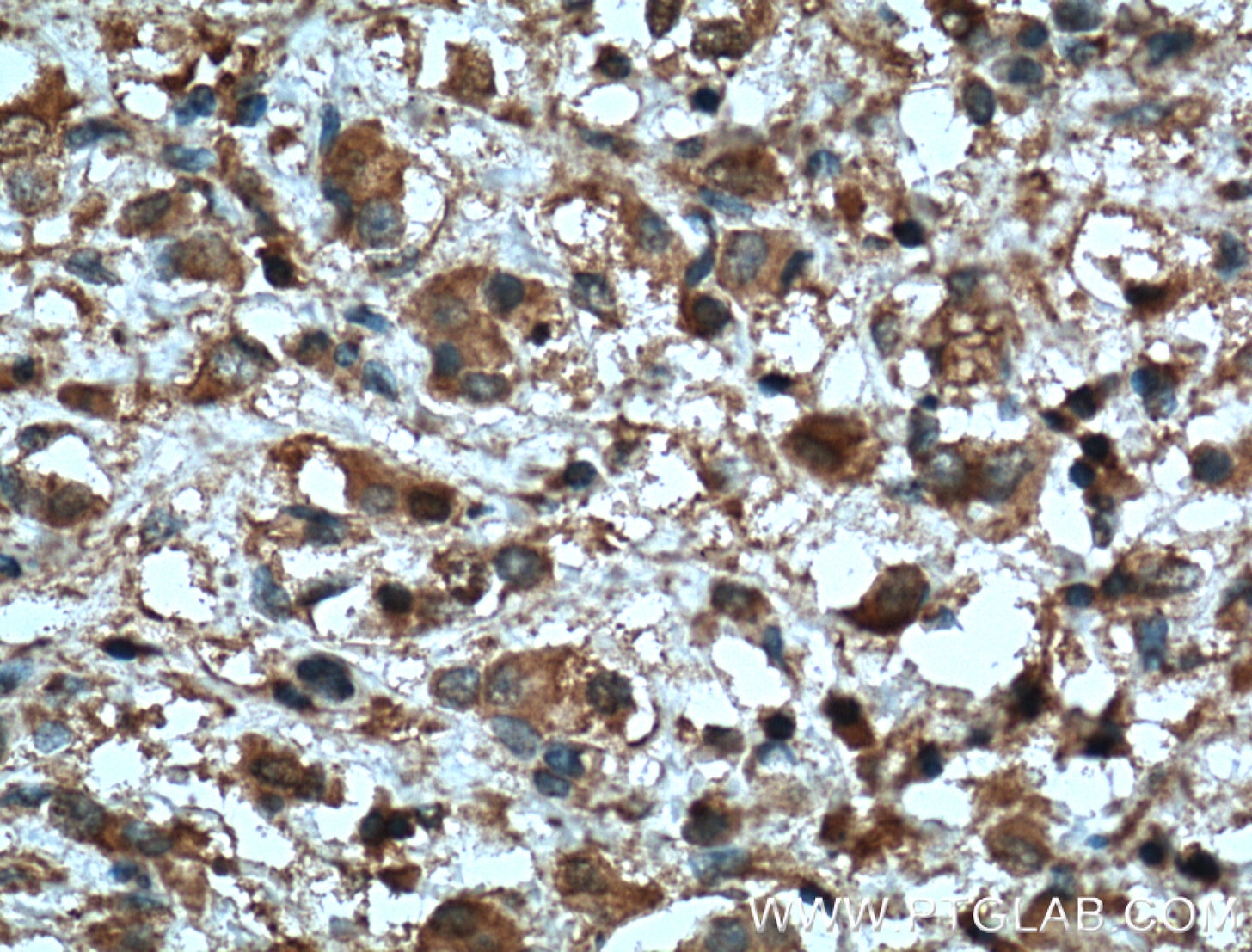 Immunohistochemistry (IHC) staining of human breast cancer tissue using MMP2 Monoclonal antibody (66366-1-Ig)