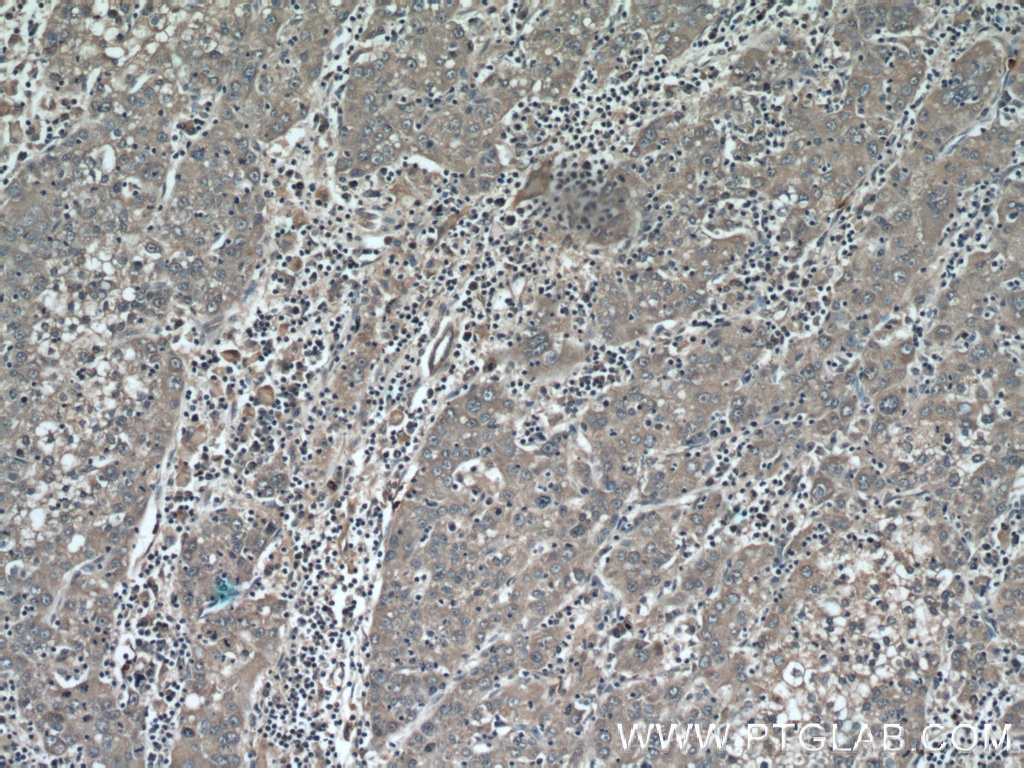 Immunohistochemistry (IHC) staining of human liver cancer tissue using MMP20 Polyclonal antibody (55467-1-AP)