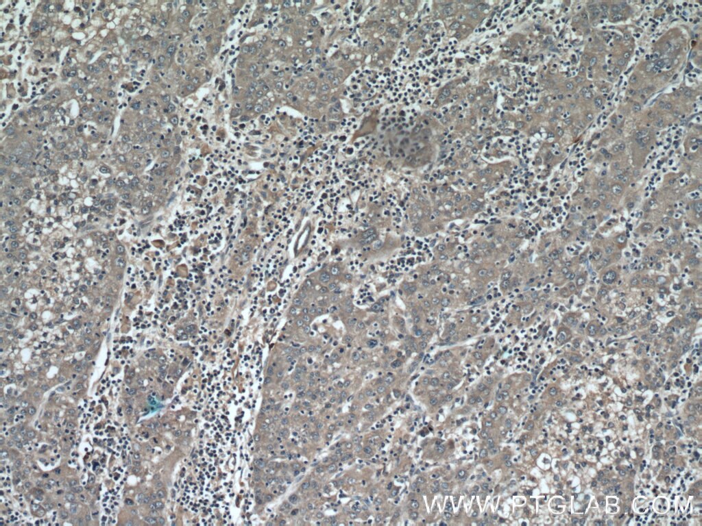 Immunohistochemistry (IHC) staining of human liver cancer tissue using MMP20 Polyclonal antibody (55467-1-AP)